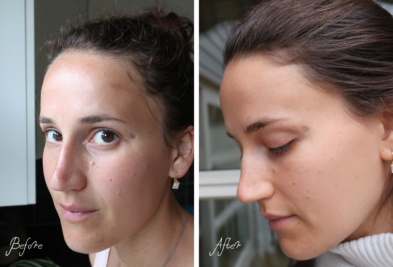 hyperpigmentation before and after